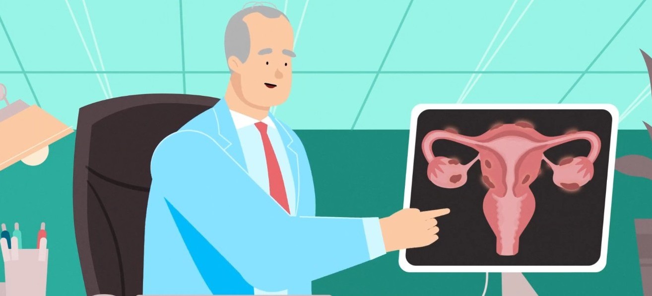 Endometriózis és PCOS